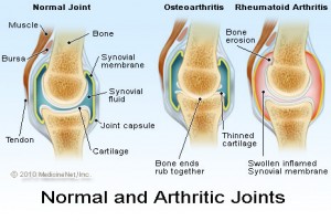 osteoarthritis treatment victoria bc