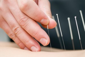 How Acupuncture Can Help With Seasonal Allergies 