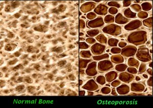 Preventing & Reversing Osteoporosis 