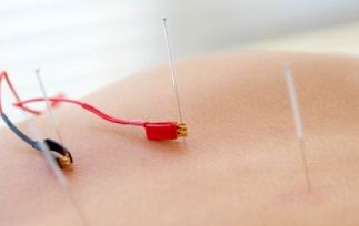 Image result for electro-acupuncture