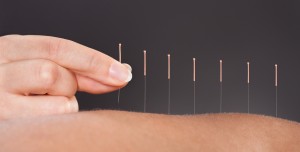 acupuncture