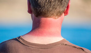 sunburn_300x174_479516899