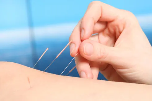 acupuncture victoria bc