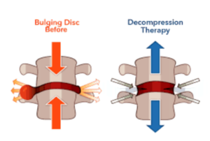 Before and After Spinal Decompression Therapy