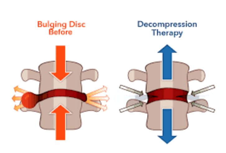 Spinal Decompression Therapy Explained - Diversified Health Clinic