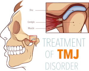 TMJ Disorder Treatment